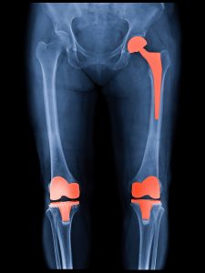 x-ray in gray showing hip and knee replacements in orange